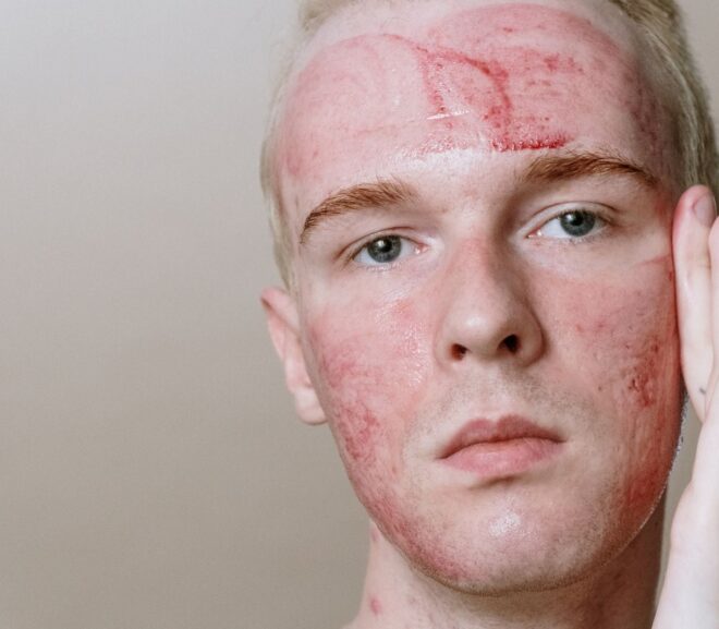 Rosacea og bumsecreme